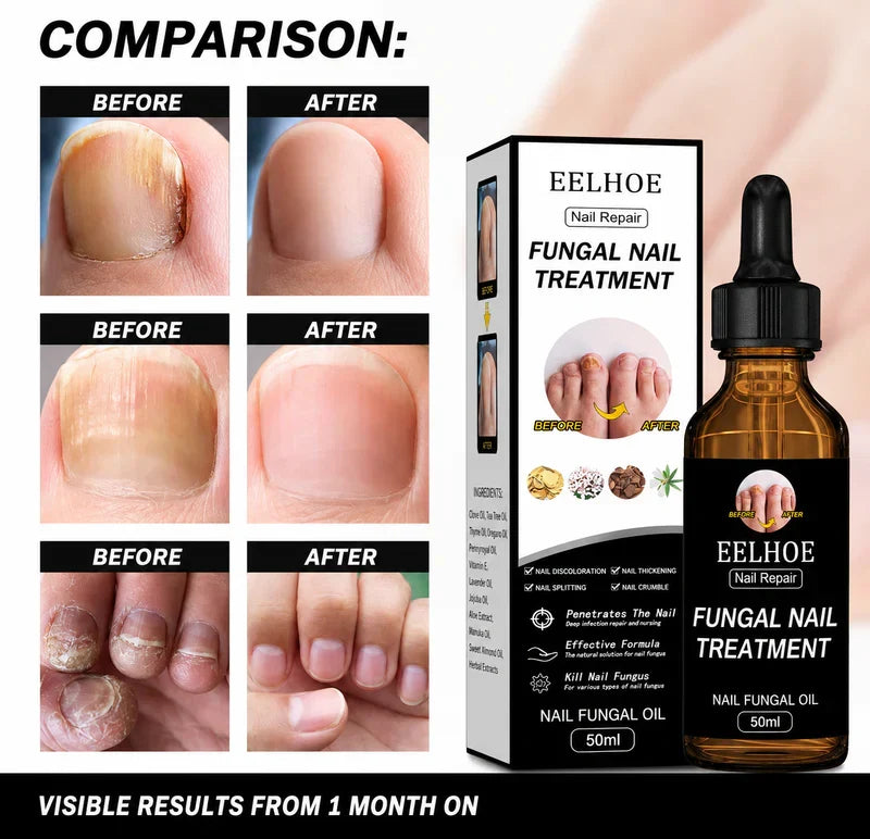 Fungal Nail Treatment Oil